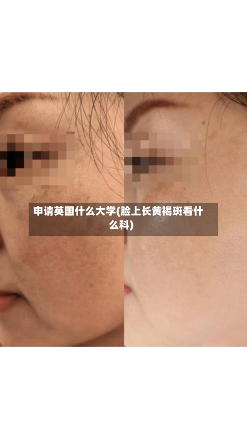 申请英国什么大学(脸上长黄褐斑看什么科)