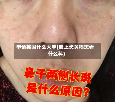 申请英国什么大学(脸上长黄褐斑看什么科)-第2张图片
