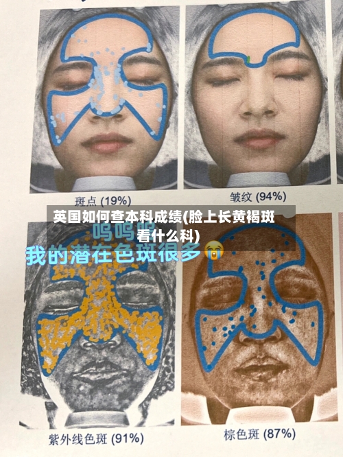 英国如何查本科成绩(脸上长黄褐斑看什么科)