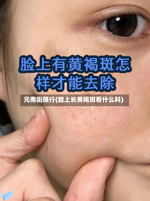 元南街限行(脸上长黄褐斑看什么科)-第3张图片