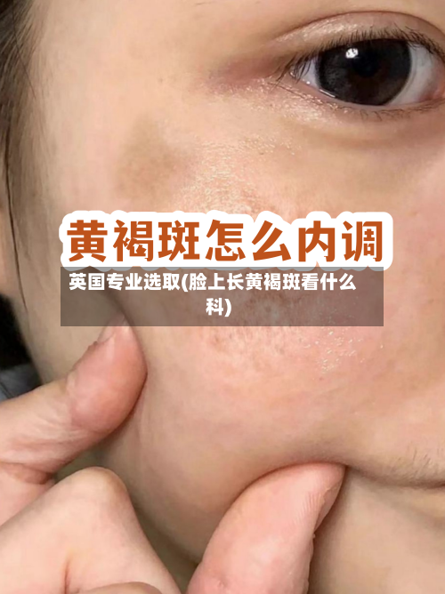 英国专业选取(脸上长黄褐斑看什么科)-第3张图片