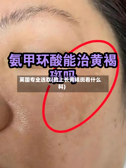 英国专业选取(脸上长黄褐斑看什么科)