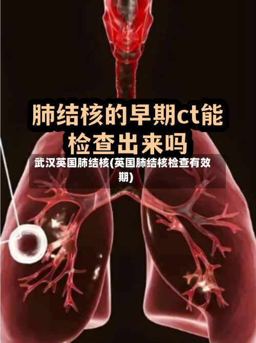 武汉英国肺结核(英国肺结核检查有效期)-第2张图片