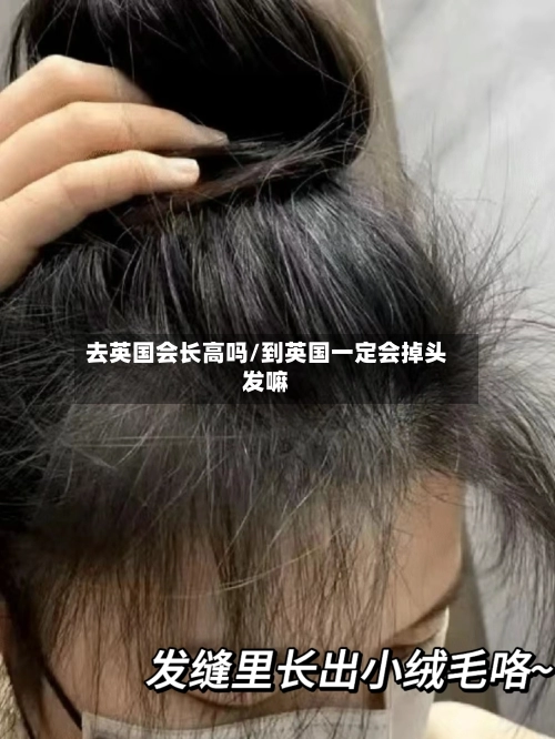 去英国会长高吗/到英国一定会掉头发嘛-第2张图片